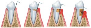 Periodontal Therapy